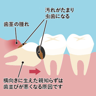 歯並びが悪くなる